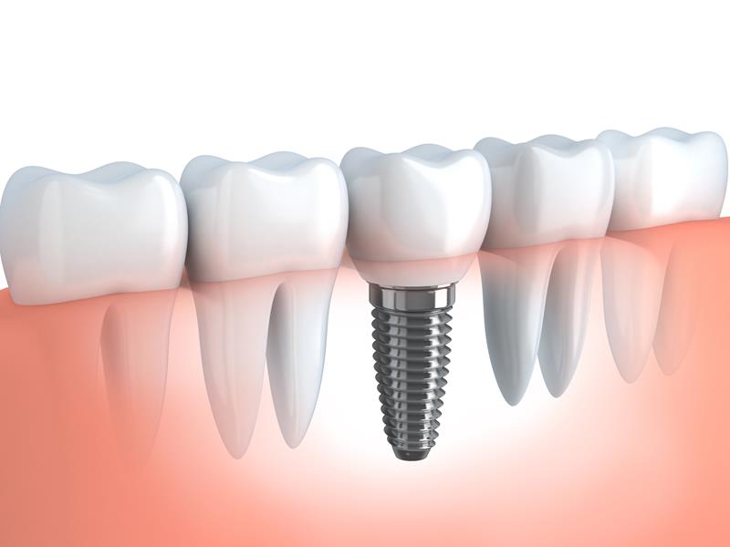 Dental Implants  Seattle, WA 
